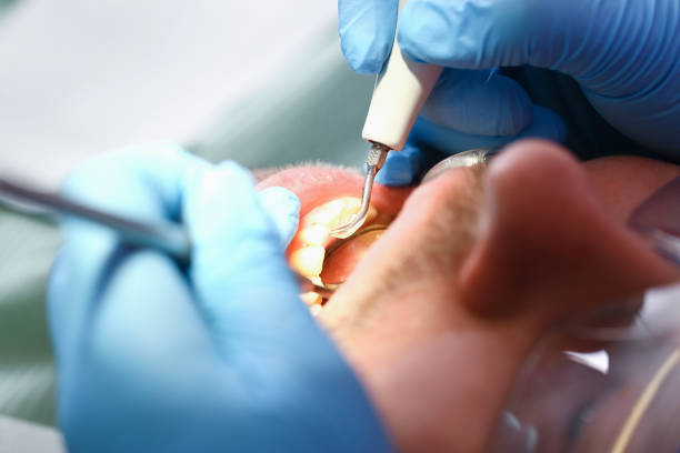 Best Emergency Dentist for Lost Fillings or Crowns in New Sharon, IA