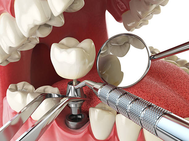 Best Emergency Root Canal Treatment in New Sharon, IA